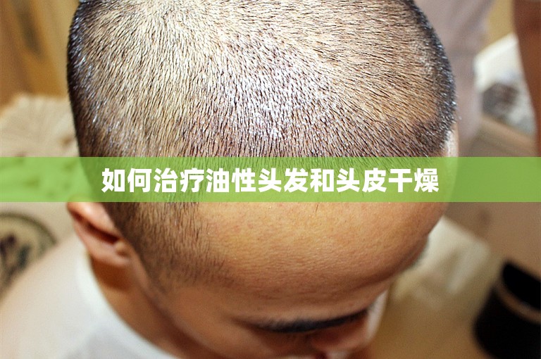 如何治疗油性头发和头皮干燥