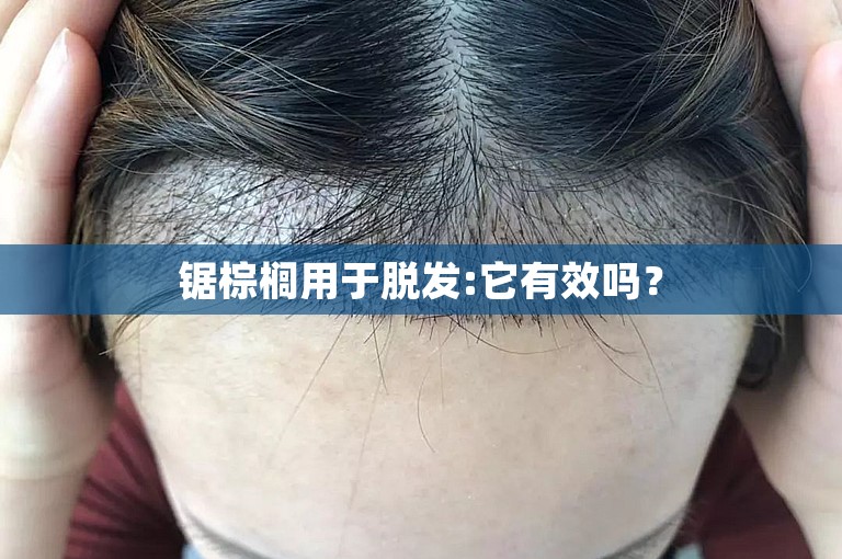 锯棕榈用于脱发:它有效吗？