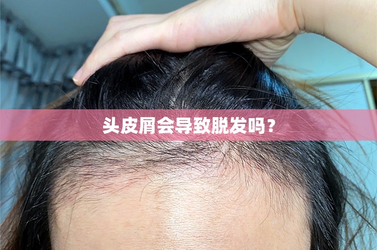 头皮屑会导致脱发吗？