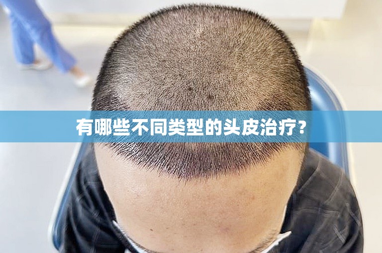 有哪些不同类型的头皮治疗？
