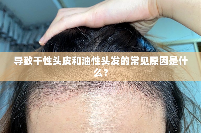 导致干性头皮和油性头发的常见原因是什么？