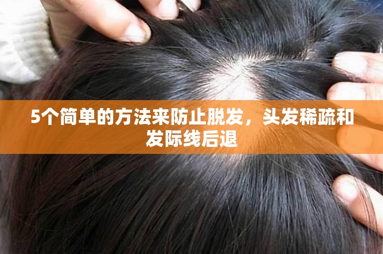 5个简单的方法来防止脱发，头发稀疏和发际线后退