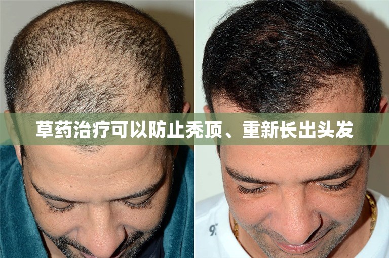 草药治疗可以防止秃顶、重新长出头发