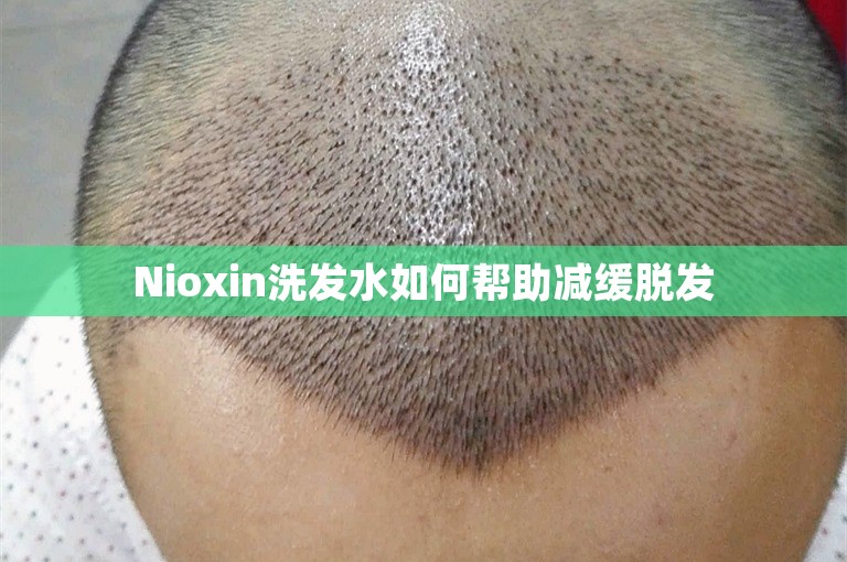 Nioxin洗发水如何帮助减缓脱发