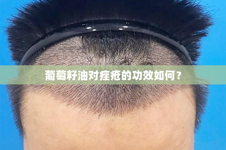 葡萄籽油对痤疮的功效如何？