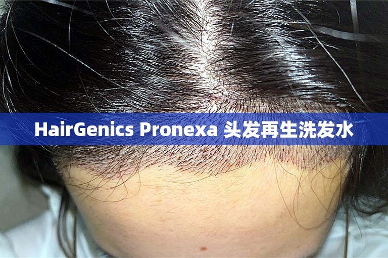 HairGenics Pronexa 头发再生洗发水