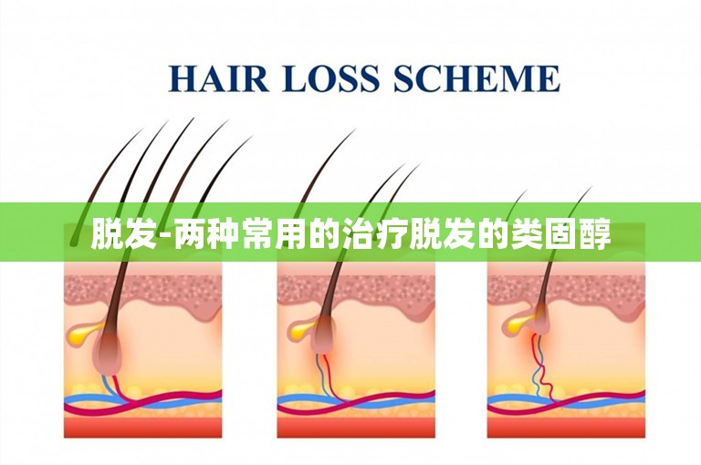 脱发-两种常用的治疗脱发的类固醇