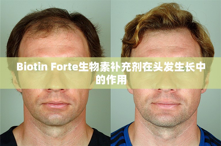 Biotin Forte生物素补充剂在头发生长中的作用