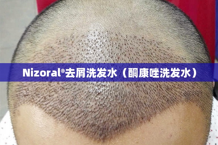 Nizoral®去屑洗发水（酮康唑洗发水）