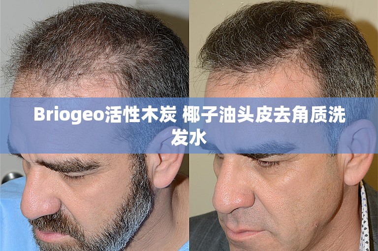 Briogeo活性木炭 椰子油头皮去角质洗发水