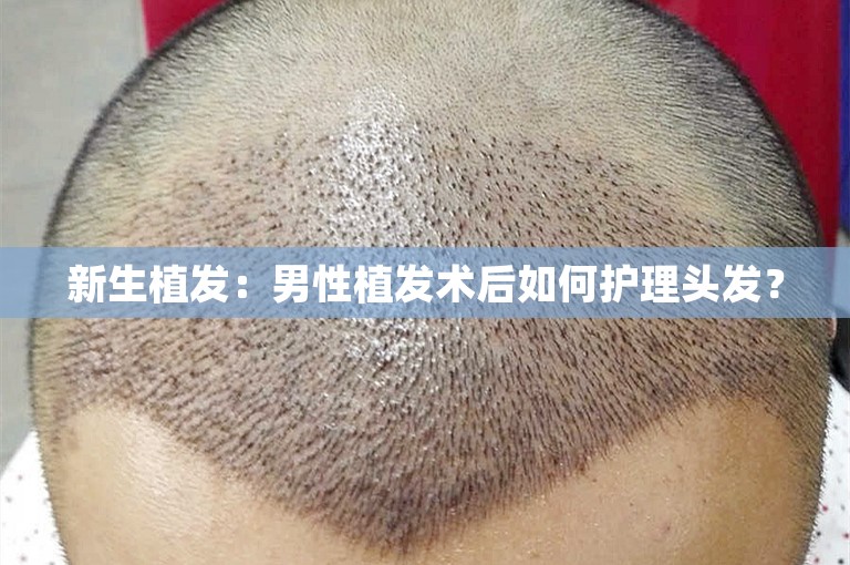 新生植发：男性植发术后如何护理头发？
