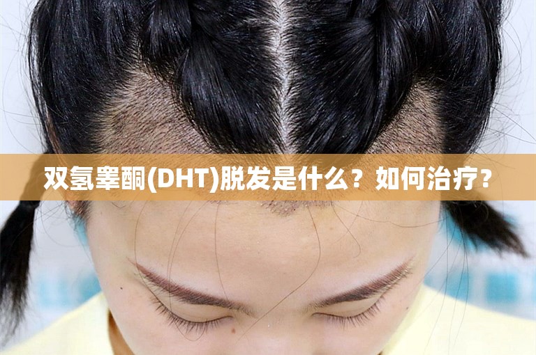 双氢睾酮(DHT)脱发是什么？如何治疗？