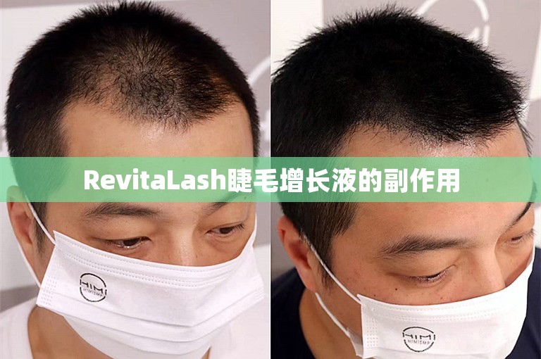RevitaLash睫毛增长液的副作用