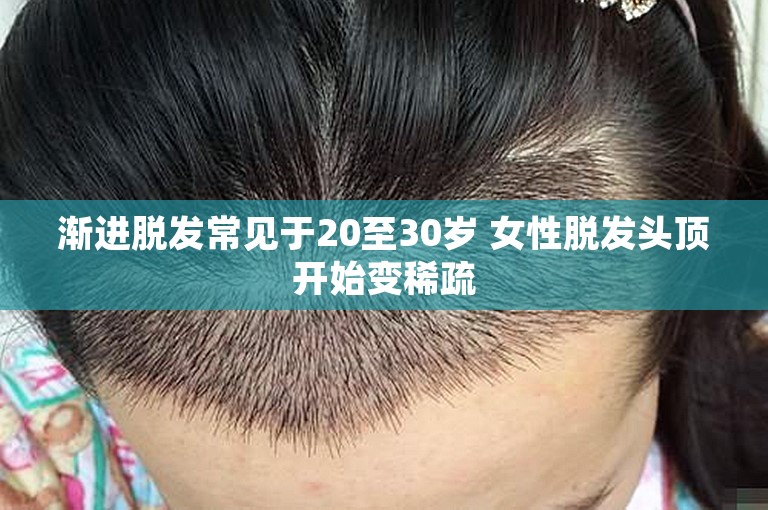 渐进脱发常见于20至30岁 女性脱发头顶开始变稀疏