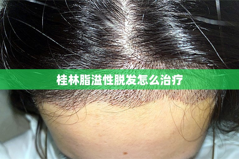 桂林脂溢性脱发怎么治疗