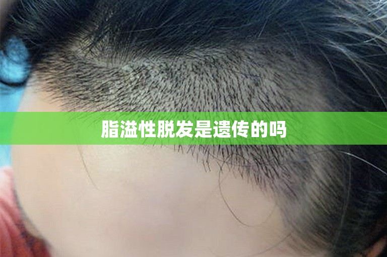 脂溢性脱发是遗传的吗