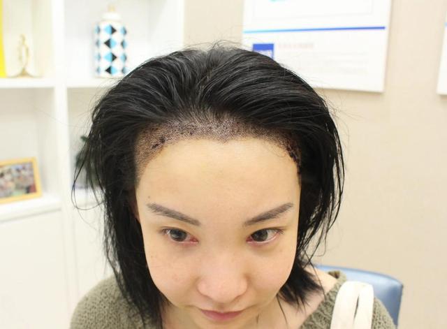 百星植发：植发后的护理技巧