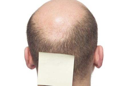男性脱发最常见的误区，能治疗男性脱发的偏方