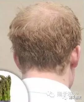 英国哈里王子下半年植发怎么还没植发？