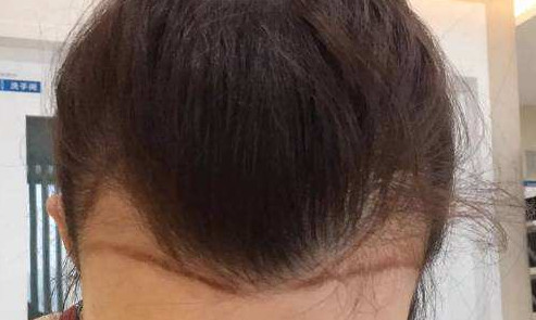 头发油对植发效果有影响吗？