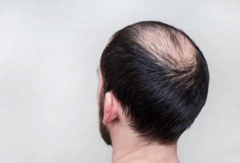 头发移植手术一般是取哪里的毛囊