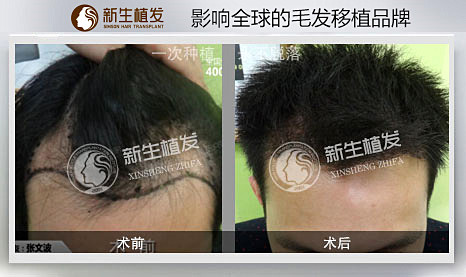 在杭州怎样选择好的植发医院？