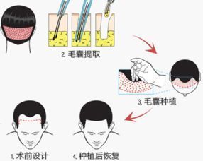 武汉哪家植发医院比较好？