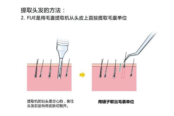 疤痕植发后头发会脱落吗