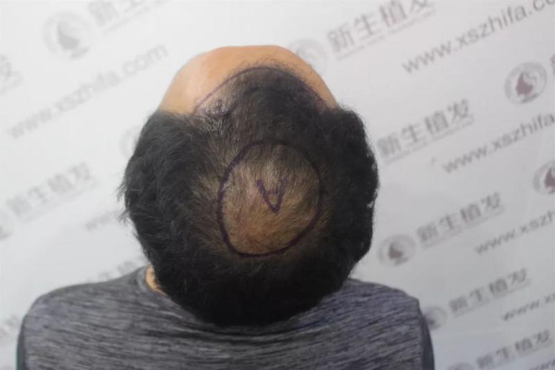秃顶有损形象，看看植发后的效果