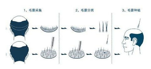 植发手术后还需要继续用药么？