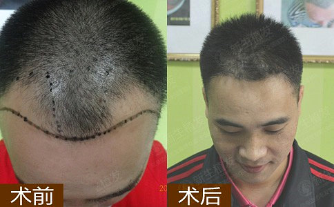 杭州植发的危害有哪些