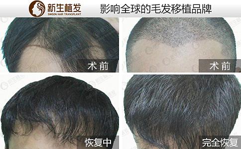 杭州植发专家让你尽早知道脱发前征兆