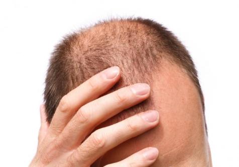 男性植发有用么？或许这是治疗脱发的圣杯