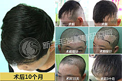 治疗男性脱发广州植发医院哪家可信？