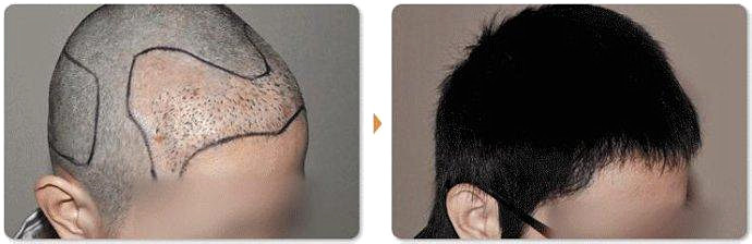 杭州植发医院种植头发能改善脱发吗