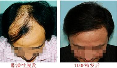 杭州毛发移植头发密度