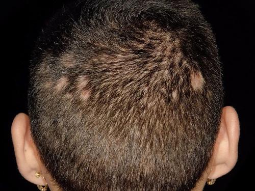 大麦微针植发专家陈鑫：瘢痕性脱发，植发切记注意这几点