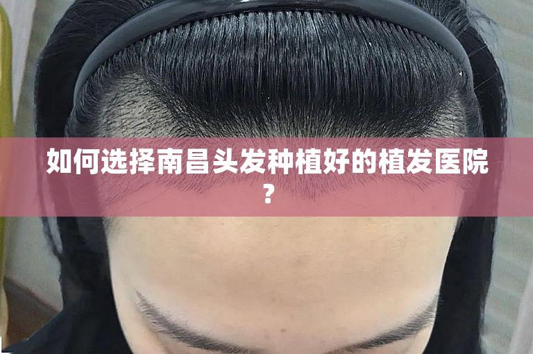 如何选择南昌头发种植好的植发医院？