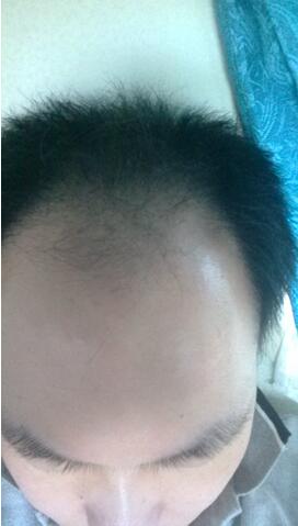 广州碧莲盛做的植发，6个月的时候效果就很不错了哦