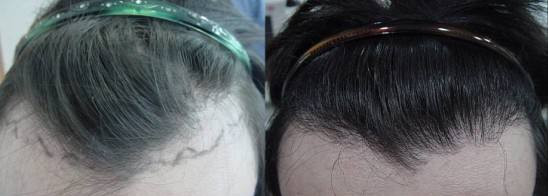 女性植发有什么副作用吗？女性植发效果好吗？