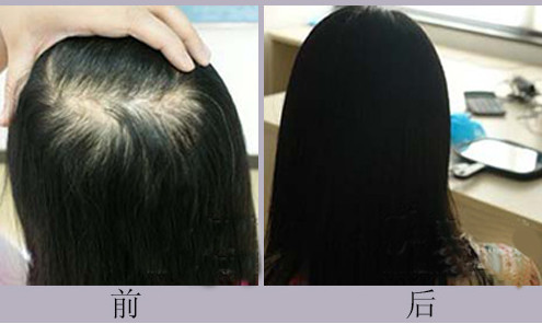 女性植发效果保持多久？植发需要多长时间？