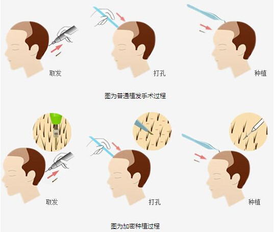 头发种植能有效改善脱发情况吗？