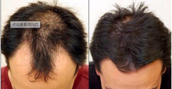头发移植手术疼吗，毛发种植的后遗症是什么