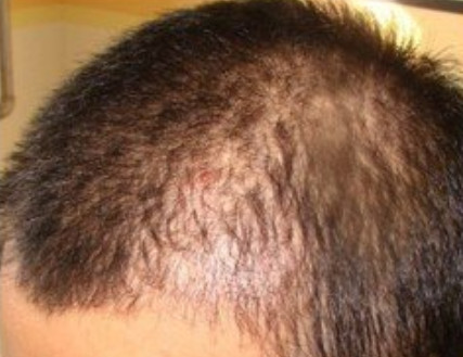 头发种植失败的因素有哪些