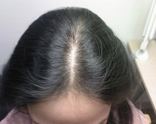 女性中年脱发可以种植吗