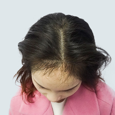 成都首瑞做发缝稀少加密术后恢复效果案例