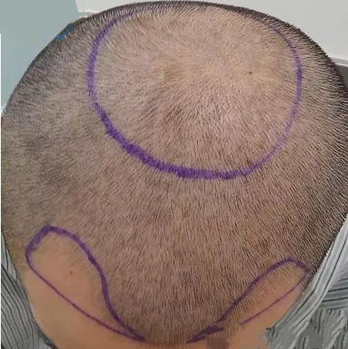M型 O型脱发治疗，发际线 头顶加密手术效果分享