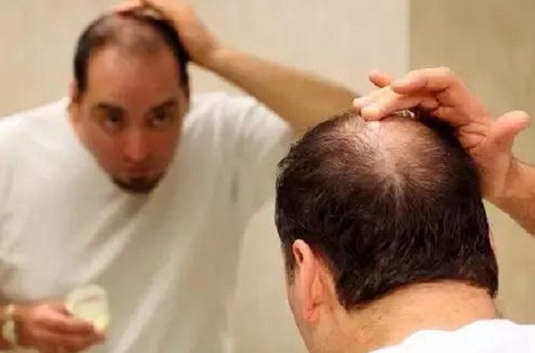 治疗脱发药物有副作用吗