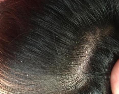 头皮屑多的原因是什么，会引起脱发吗