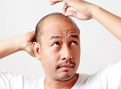 脂康宁可以治疗溢脂性脱发吗